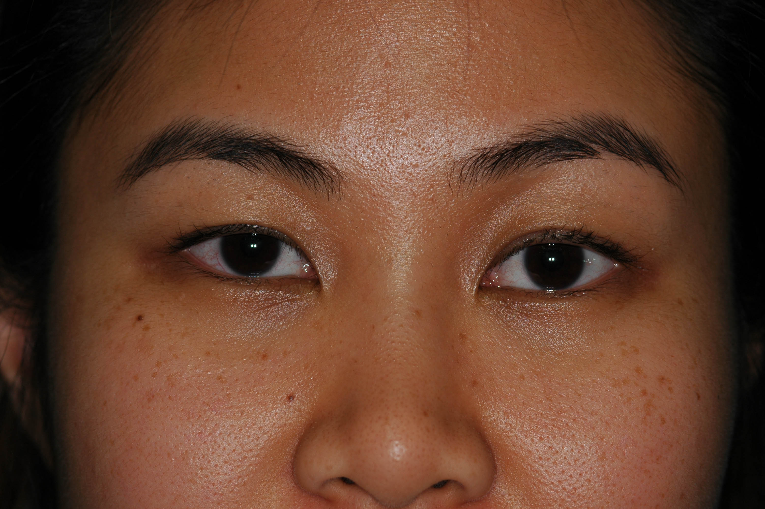 Before and After double eyelid 3