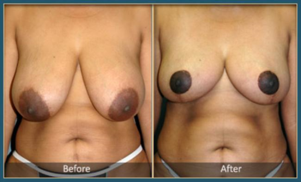 Before and After Breast Reduction 1