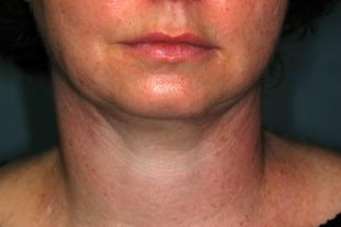 Before and After Chin and Neck 3