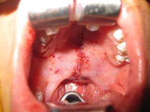 Before and After Cleft Palate