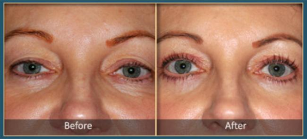 Before and After blepharoplasty 6