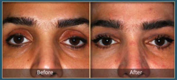 Before and After blepharoplasty 5